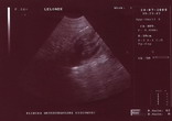Na zdjęciu USG komora zarodkowa
