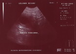 Na zdjęciu USG komora zarodkowa