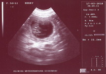 Na zdjęciu USG widoczny płód