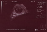 Na zdjęciu USG, komora zarodkowa z widocznym płodem