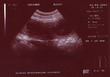 Na zdjęciu USG komora zarodkowa z widocznym płodem
