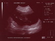 Na zdjęciu USG komora zarodkowa z widocznym płodem